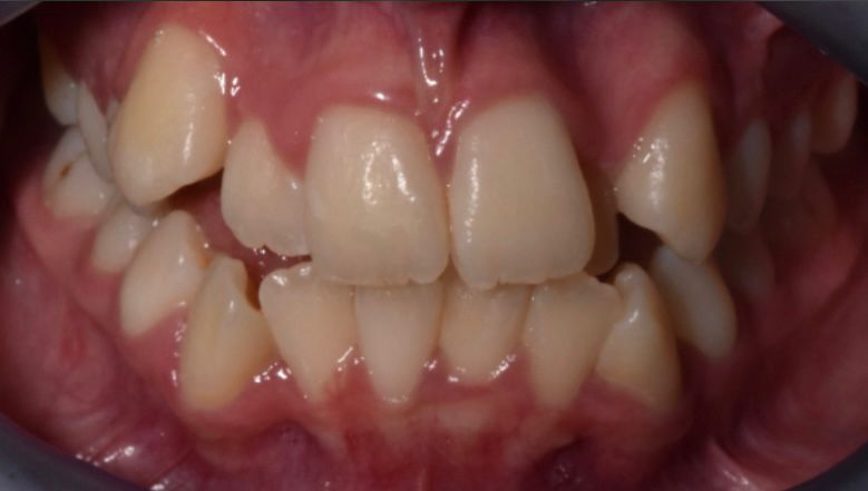 Mal posición dental