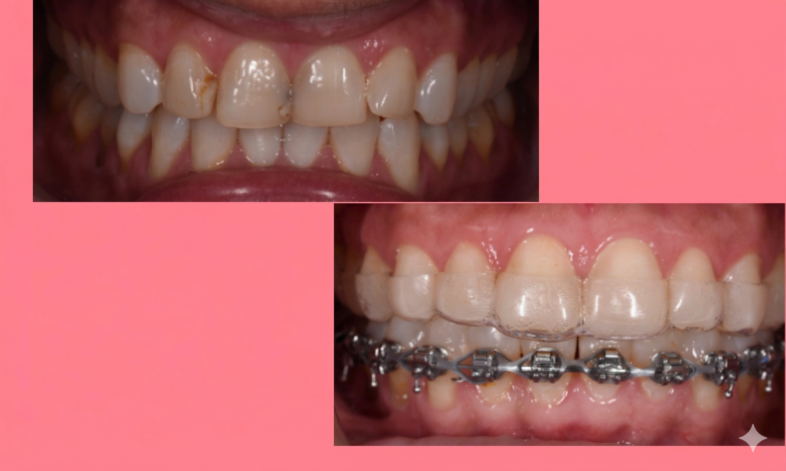 Brackets